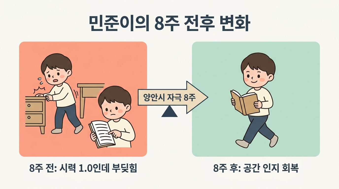6살 민준이 양안시 자극 8주 전후 변화 비교 문틀 부딪힘과 책 줄 놓침에서 공간 인지와 책 읽기 회복 일러스트 분할 한글 라벨 비교 인포그래픽