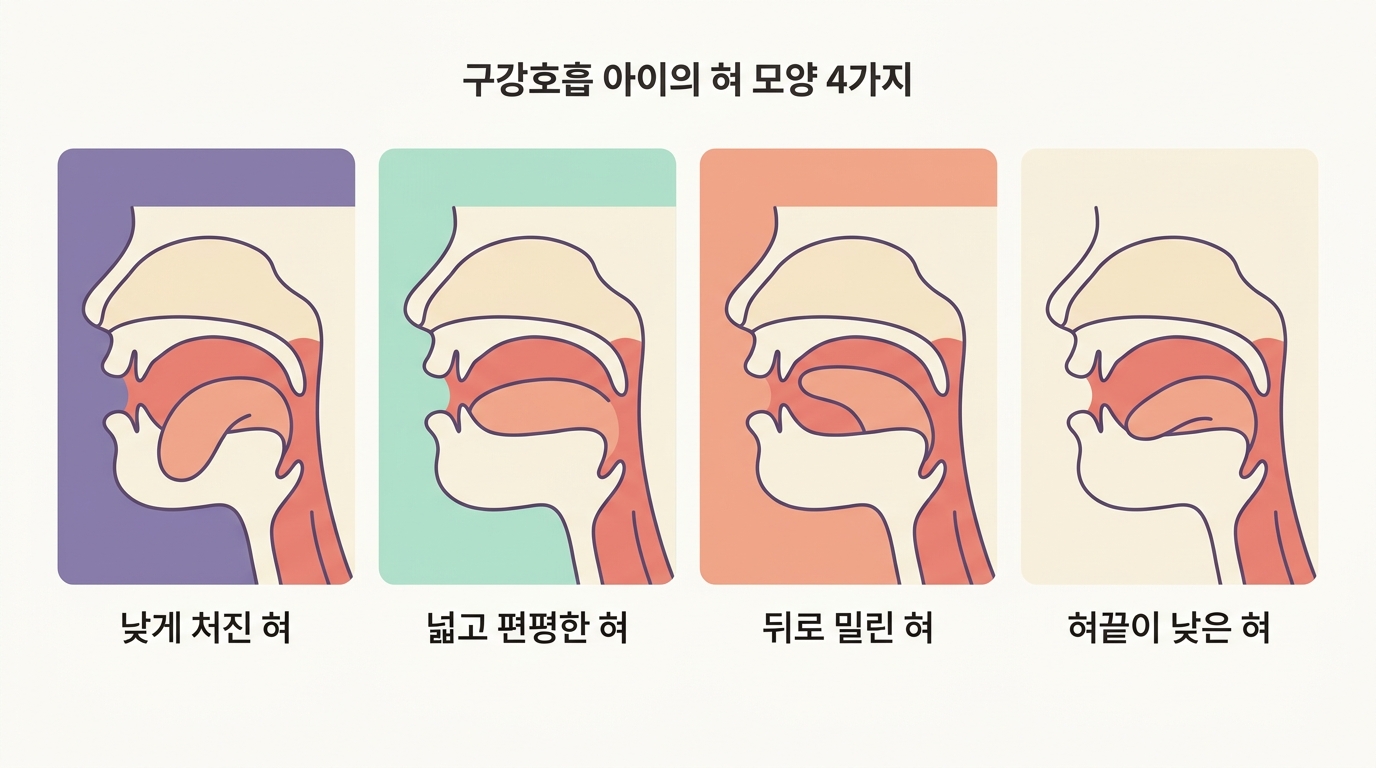 구강호흡 아이에게 흔한 낮은 혀 넓은 혀 뒤로 밀린 혀 혀끝 저위 네 가지 혀 모양을 나란히 비교한 일러스트 인포그래픽